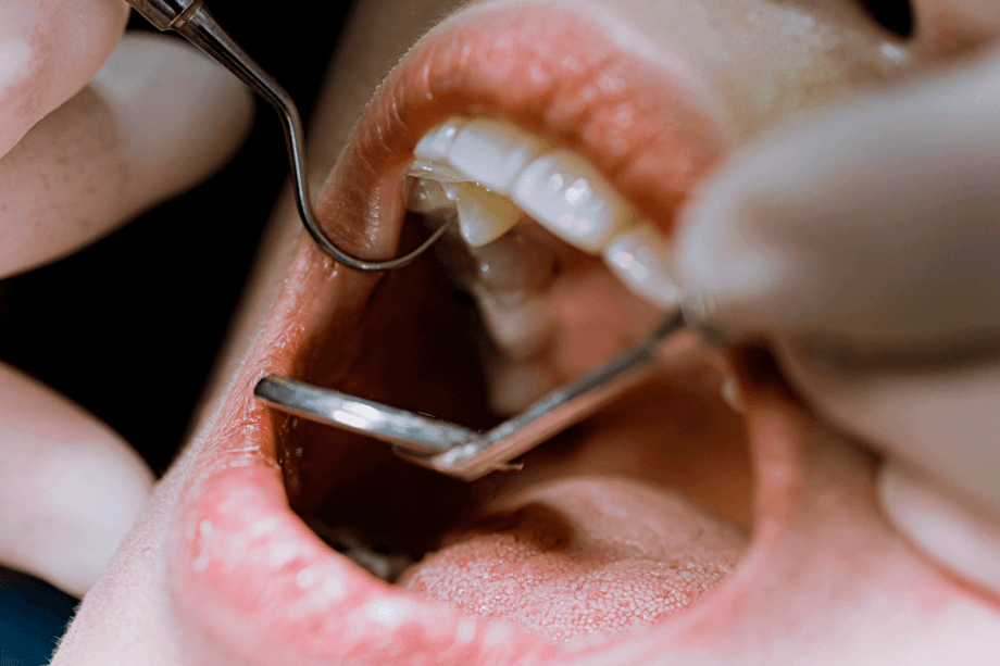 3 Signs You Need a Root Canal