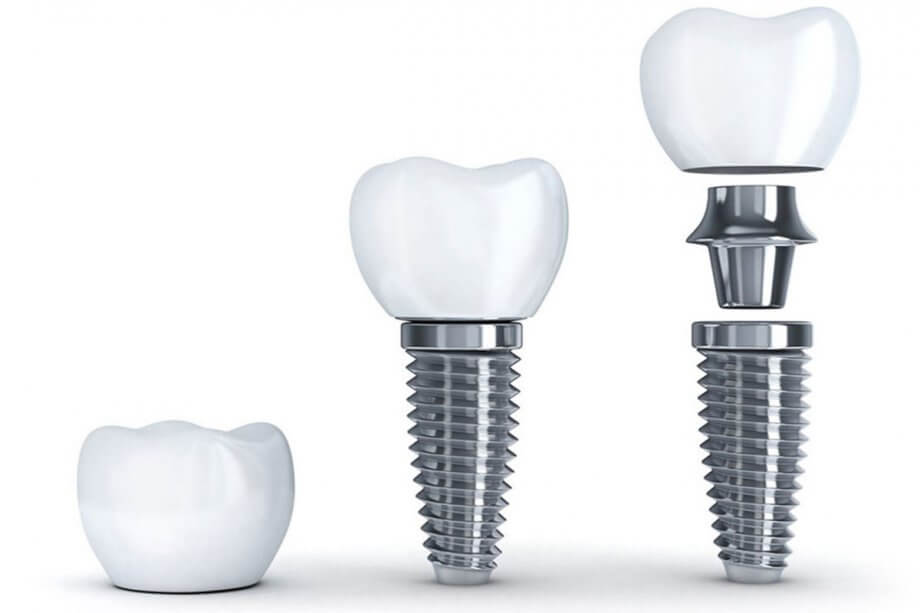 4 Myths About Dental Implants