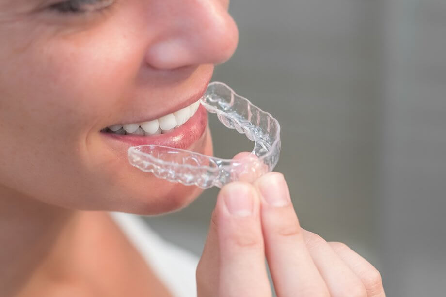 How Long Do You Have To Wear Clear Aligners