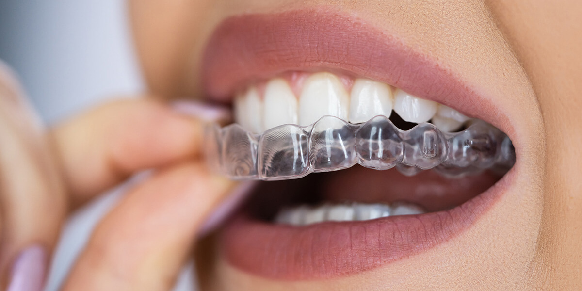 clear aligners