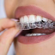 Clear Aligners