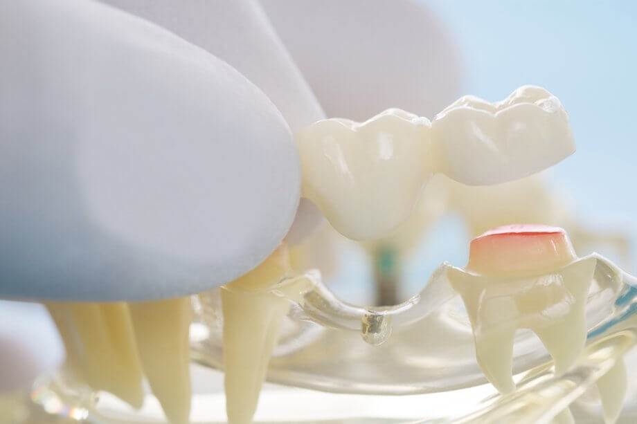Dental Bridge vs Implant: Which is Better?