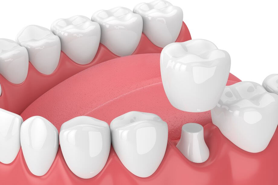 How Do Dental Crowns Affect The Appearance Of Your Smile?