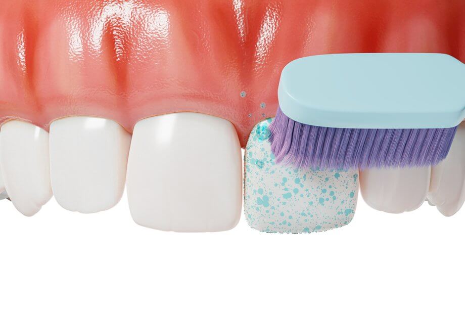 How Often Should You Get a Dental Cleaning in Westford & Bedford?
