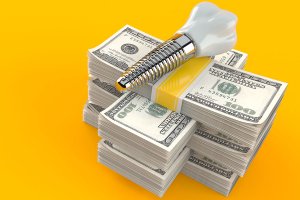 Dental Implant Financing Options