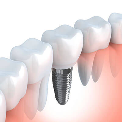 Dental Implants in Westford, MA