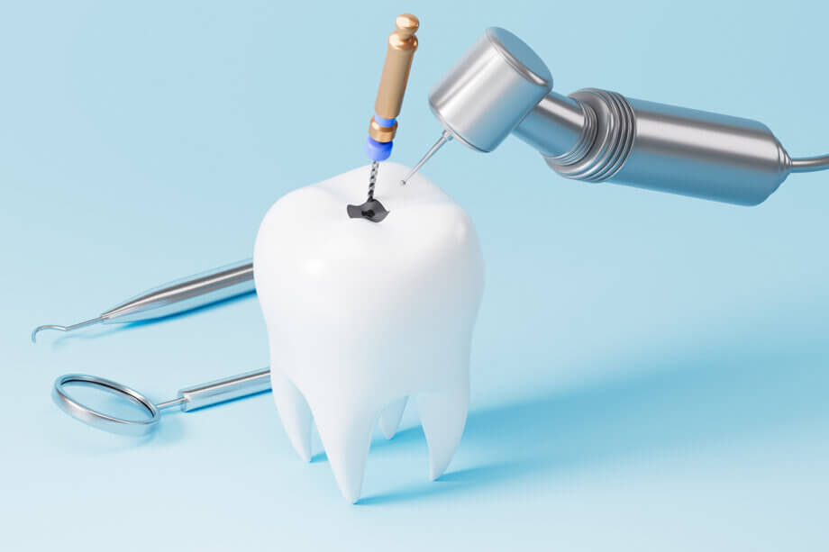 Is a Root Canal Worth the Cost? Pricing and Value at Emerson Dental