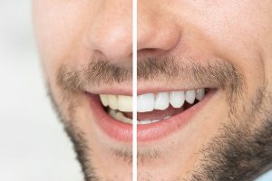 before and after picture of mouth with whitening
