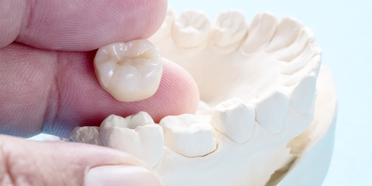 Dental Crowns in Westford, MA