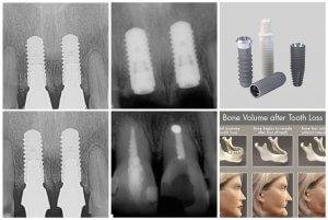 The 4 Benefits of Dental Implants