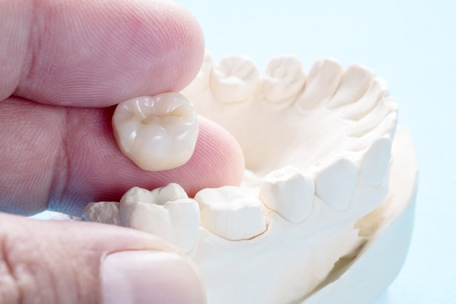 What Are Dental Crowns Made Out Of?
